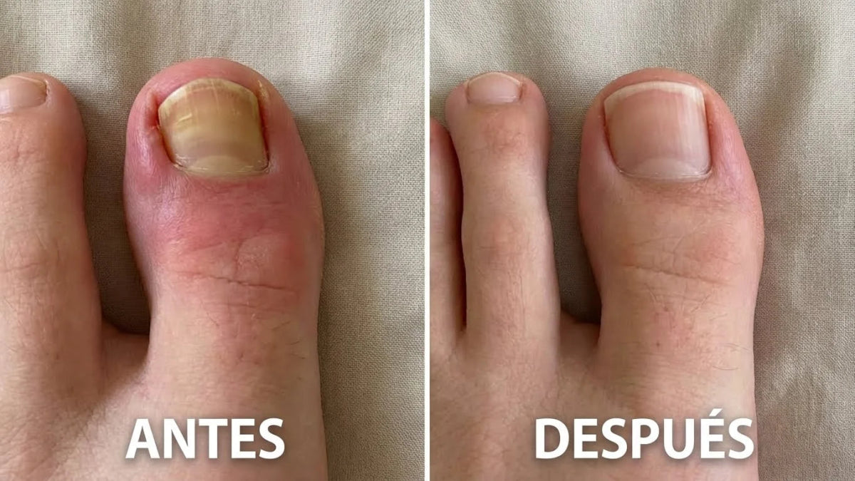 NailFix Ultra™️: Parche Corrector de Uñas - jomaka.cl